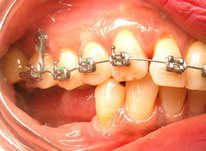 Ortodoncia en Implantología Dental » DR. MOLINA MOGUEL 11 Ortodoncia en Implantología Dental