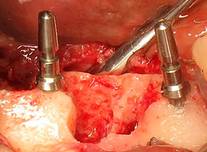 Ortodoncia en Implantología Dental