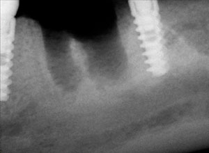 Ortodoncia en Implantología Dental » DR. MOLINA MOGUEL 14 Ortodoncia en Implantología Dental