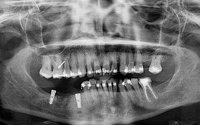 Ortodoncia en Implantología Dental » DR. MOLINA MOGUEL 15 Ortodoncia en Implantología Dental