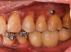 Ortodoncia en Implantología Dental » DR. MOLINA MOGUEL 16 Ortodoncia en Implantología Dental