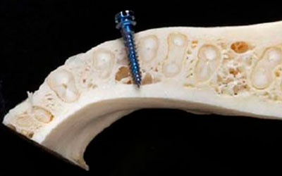 Ortodoncia en Implantología Dental » DR. MOLINA MOGUEL 5 Ortodoncia en Implantología Dental