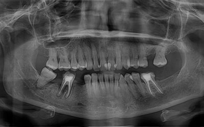 Ortodoncia en Implantología Dental » DR. MOLINA MOGUEL 6 Ortodoncia en Implantología Dental
