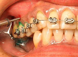 Ortodoncia en Implantología Dental » DR. MOLINA MOGUEL 7 Ortodoncia en Implantología Dental