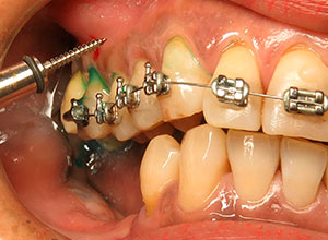 Ortodoncia en Implantología Dental