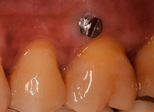 Ortodoncia en Implantología Dental » DR. MOLINA MOGUEL 9 Ortodoncia en Implantología Dental