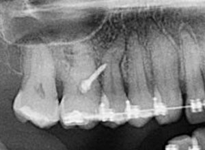 Ortodoncia en Implantología Dental » DR. MOLINA MOGUEL 10 Ortodoncia en Implantología Dental