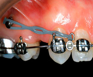 Ortodoncia en Implantología