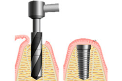 Osteointegración