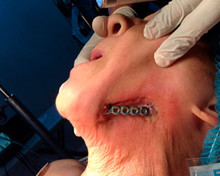 Paciente implantes dentales - bifosfonato