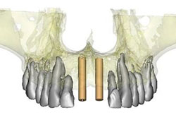 Planificación 3d de implantes