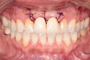 Planificación Quirúrgica 3D en Implantes Dentales