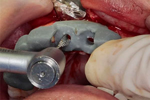 Planificación Quirúrgica 3D en Implantes Dentales