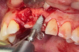 Planificación Quirúrgica 3D en Implantes Dentales