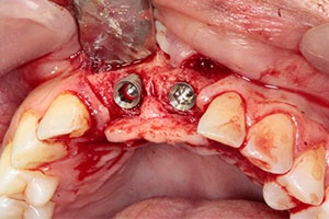 Planificación Quirúrgica 3D en Implantes Dentales