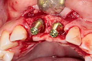 Planificación Quirúrgica 3D en Implantes Dentales