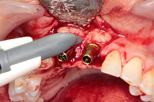 Planificación Quirúrgica 3D en Implantes Dentales
