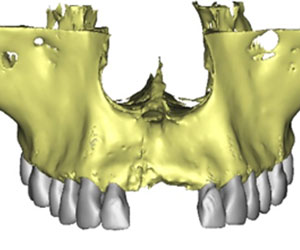 Planificación quirúrgica 3D