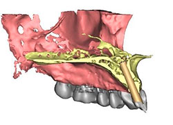 Planificación de implantes