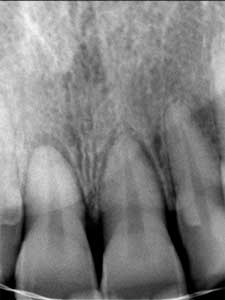 Radiografía Periapical