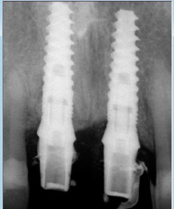 Radiografía