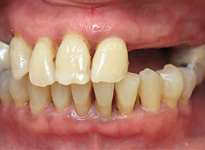 Rehabilitación Protesica con Enfermedad Periodontal