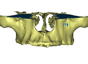 Rehabilitación Protesica con Enfermedad Periodontal
