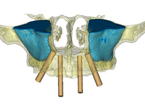 Rehabilitación Protesica con Enfermedad Periodontal