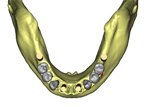 Rehabilitación Protesica con Enfermedad Periodontal