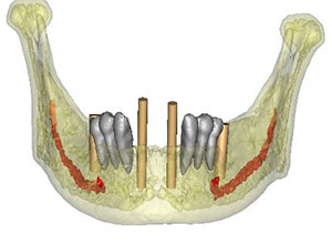 Rehabilitación Protesica con Enfermedad Periodontal