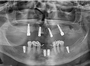 Rehabilitación Protesica con Enfermedad Periodontal