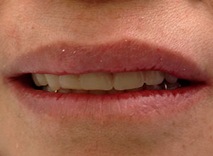 Rehabilitación Protesica con Enfermedad Periodontal