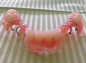 Rehabilitación Protesica con Enfermedad Periodontal