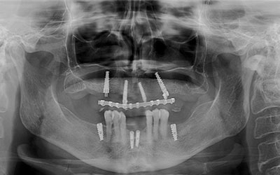 Rehabilitación Protesica con Enfermedad Periodontal