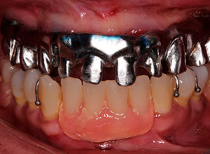 Rehabilitación Protesica con Enfermedad Periodontal