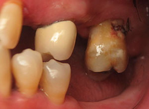 Rehabilitación Protesica con Enfermedad Periodontal
