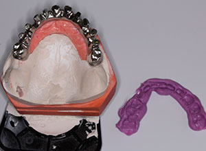 Rehabilitación Protesica con Enfermedad Periodontal