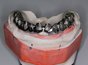 Rehabilitación Protesica con Enfermedad Periodontal