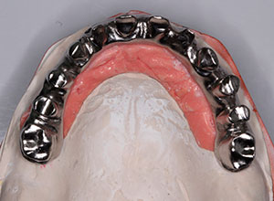 Rehabilitación Protesica con Enfermedad Periodontal