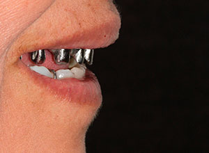 Rehabilitación Protesica con Enfermedad Periodontal