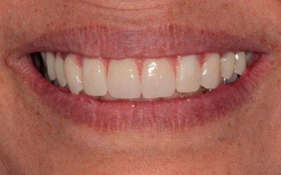 Rehabilitación Protesica con Enfermedad Periodontal