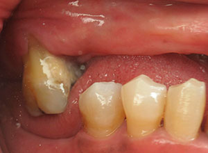 Rehabilitación Protesica con Enfermedad Periodontal