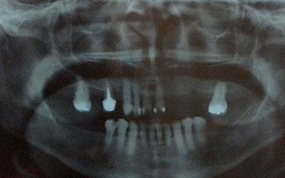 Rehabilitación Protesica con Enfermedad Periodontal