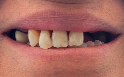 Rehabilitación Protesica con Enfermedad Periodontal