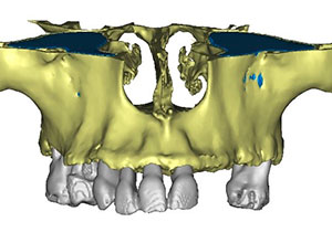 Rehabilitación Protesica con Enfermedad Periodontal