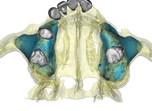 Rehabilitación Protesica con Enfermedad Periodontal