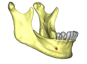 Rehabilitación Protesica con Enfermedad Periodontal