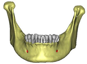 Rehabilitación Protesica con Enfermedad Periodontal