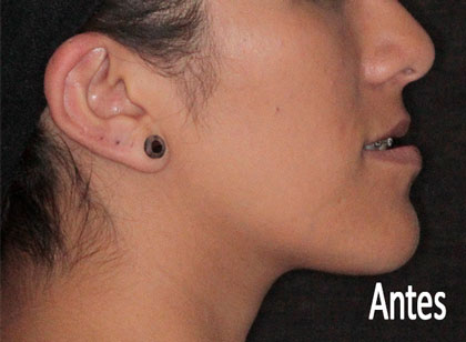 Cirugía Ortognatica Antes y Después