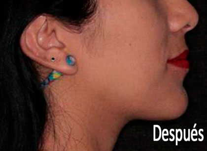 Cirugía Ortognatica Antes y Después